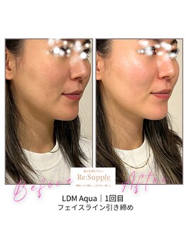 リサプリ(Re: Supple)/スッキリ!フェイスライン