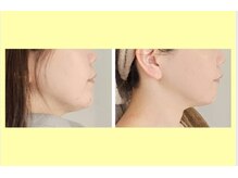 アン 銀座(ann)/レモンボトルで横顔もスッキリ