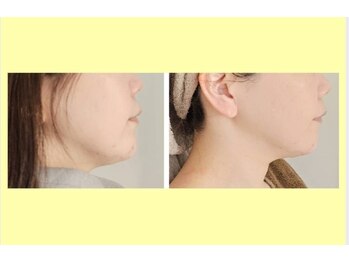 アン 銀座(ann)/レモンボトルで横顔もスッキリ