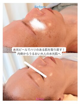 エテル(eter)の写真/大人の艶ツヤ不足でお悩みの方はこちら！内側からうるおいに満ちた大人の水光肌へ導く水光ピール