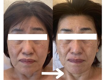 シベル(Si Belles)/1回で両頬が引き締まる!