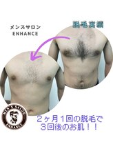 エンハンス 亀有(enhance)/脱毛実績