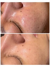 ルタンリッシュオム(Lutan Riche hom)/毛穴開き、赤み肌