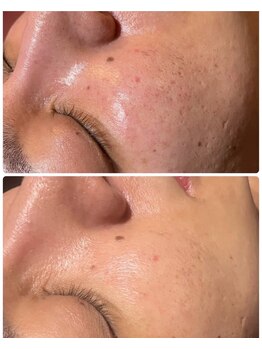 ルタンリッシュオム(Lutan Riche hom)/毛穴開き、赤み肌