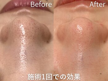 セレソル(CERESOL)/私の魔法の毛穴洗浄術