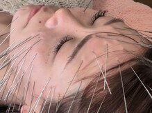 もりさわ治療院 与力町治療室 &nbsp;トサカ(TOSAKA)/【抗酸化美容鍼】