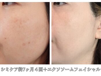 ビィーチェ(VIECE)/シミケアとフェイシャルの併用も