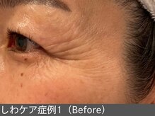 オアシスラグーン(OASIS LAGOON)/しわ改善（症例1 before）50代