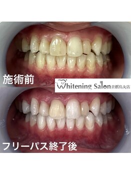 ホワイトニングサロン 京都烏丸店/ホワイトニング施術例