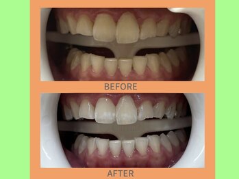 ココティ ホワイトニング(Cocotii)/ビフォーアフター