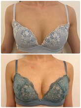 美人バスト 川崎店/バストアップ◇症例◇