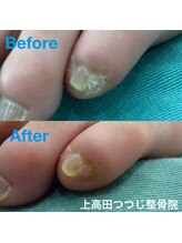 上高田つつじ整体院/フットケア　副爪ケア　施術例