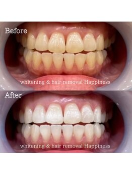 ハピネス 心斎橋アメリカ村本店(Happiness)/初めてのホワイトニング