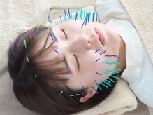 ムーブアクト 福山店(Moveact)/小顔・リフトアップ美容鍼