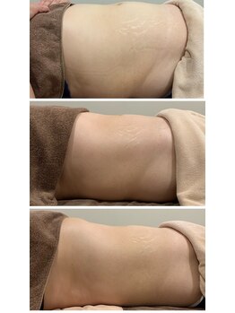 ディアウーマン(Dear Woman)/脂肪分解【スリミラボディ】