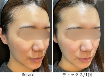 ビボーラ(BEBEAURA)/デトックスフェイシャル