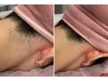 ビューティービレッジ(Beauty village)/アップスタイルもすっきり♪脱毛