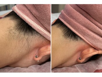 ビューティービレッジ(Beauty village)/アップスタイルもすっきり♪脱毛