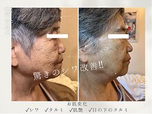 40代・50代・60代のお肌を10年前より美しく♪シワやたるみも改善
