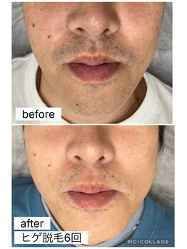 ナムズ(Nams)/全身脱毛（顔VIO込み)