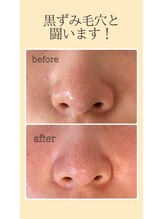 ラシュシュ(La Chou Chou)/◇角栓・黒ずみ除去◇