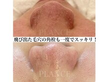プランス 渋谷(PLANCE)/毛穴のざらつき、黒ずみに！渋谷