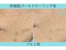 リメイククリニカルビューティー(Remake clinical beauty)/ずっと赤みが残る