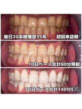 ライトビューティー 関内店(LIGHT BEAUTY)/[タバコやコーヒー等汚れを一掃]