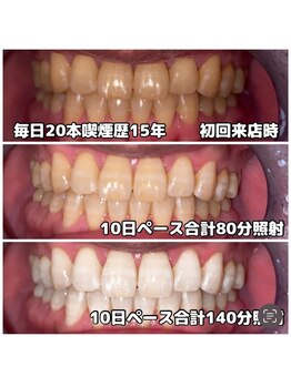 ライトビューティー 関内店(LIGHT BEAUTY)/[タバコやコーヒー等汚れを一掃]