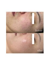 サロンドジェシカ(salon de Jessica)/頬の毛穴と全体のおシミ改善