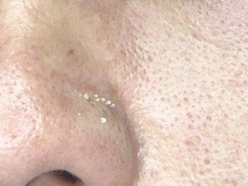 リアン(LIAN)の写真/【話題のエクストラクションプロ！】黒ずみ/開き毛穴/皮脂の分泌が気になる方におすすめ☆