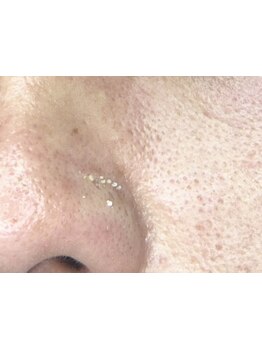 毛穴ケアをしたい