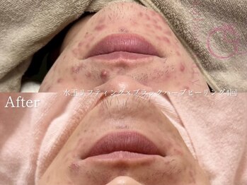 ヴェアリー 広尾(VARY)/メンズもハーブピーリング