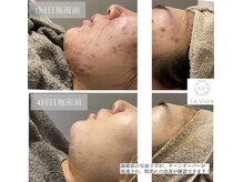 ラヴィオーラ 川崎(La Viora)/ダイヤモンドハーブピーリング