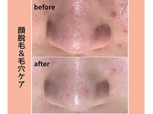 浜松富塚ベルミーランド/フェイシャルBefore→After