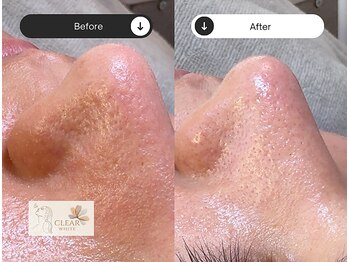 クリアホワイト(Clear White)/Before☆After