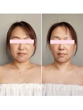 ボンヌカリテ(BONNE QUALITE)/wishpro 最新カプセル 施術写真