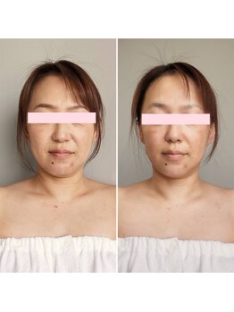 ボンヌカリテ(BONNE QUALITE)/wishpro 最新カプセル 施術写真