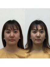 オズ六本木/六本木小顔矯正(整顔)施術1回
