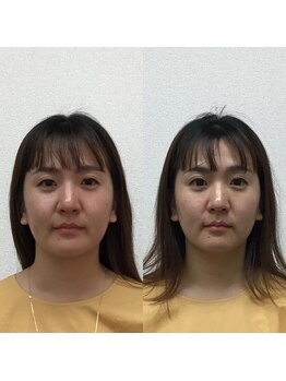オズ六本木/六本木小顔矯正(整顔)施術1回