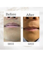 サロン ルイ(salonRui)/ひげ脱毛　before　afuta