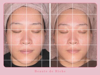 ボーテドリッシュ(Beaute de Riche)/小顔コルセットで痩せ見え◎