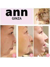 アン 銀座(ann)/#レモンボトル#エクソソーム