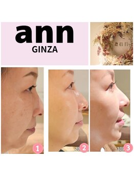 アン 銀座(ann)/#レモンボトル#エクソソーム