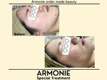 アルモニー(armonie)/肌質改善したい方！