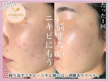 アッシュ 梅田(H)/ハーブピーリング専門Hアッシュ