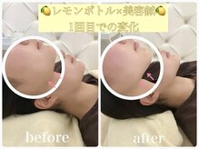 アキュモンド 渋谷院(acumond)/《むくみ撃退》速攻リフトアップ