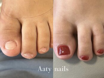 アーティネイルズ(Aaty Nails)/【深爪矯正】フット