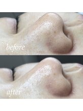 サロン ド ソワン(salon de soin)/毛穴エクストラクション