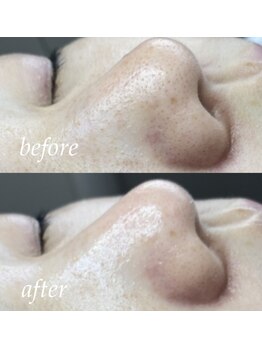 サロン ド ソワン(salon de soin)/毛穴エクストラクション